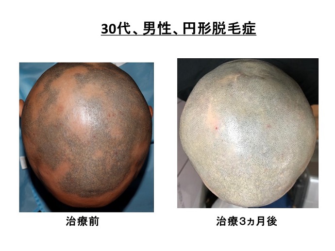 円形脱毛症　病院